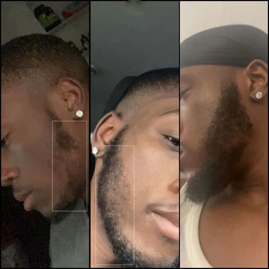 Mwezi 1 Kirkland 5% Mafuta & Derma Roller