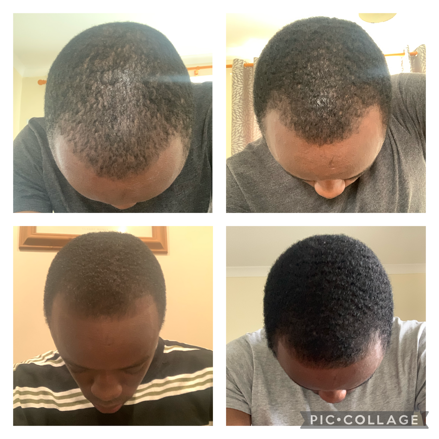 Mwezi 1 Kirkland 5% Mafuta & Derma Roller