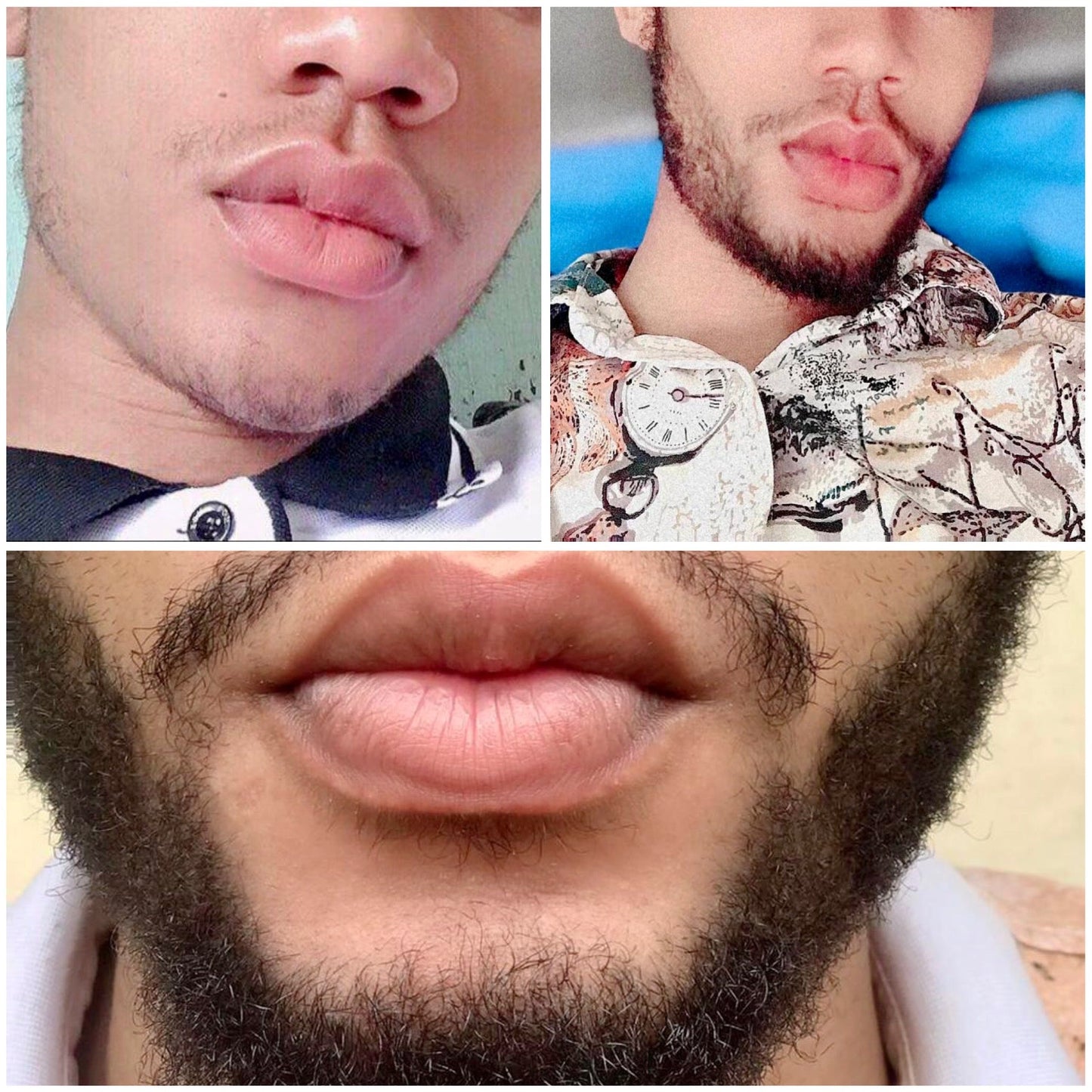 Mwezi 1 Kirkland 5% Mafuta & Derma Roller