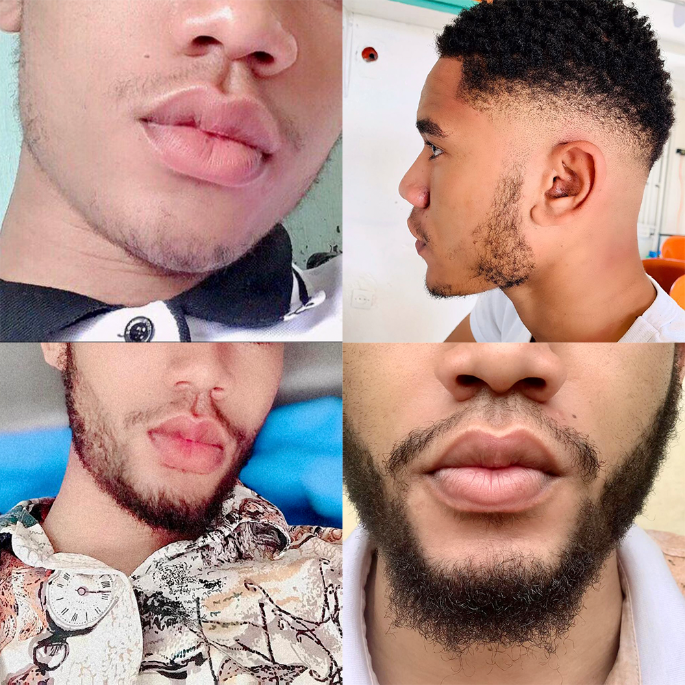 Mwezi 1 Kirkland 5% Mafuta & Derma Roller